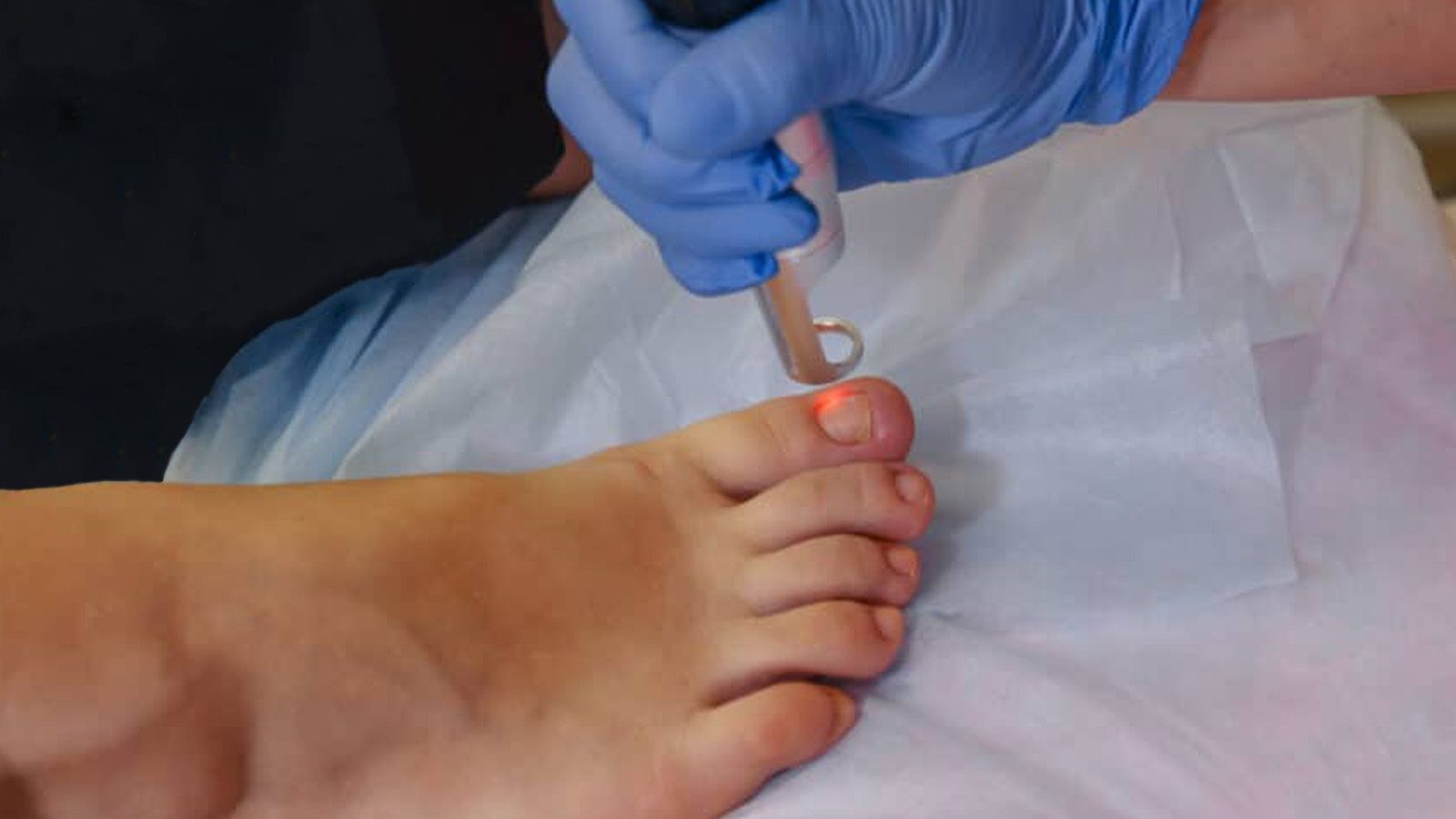 Laser nail fungus para hombres en Men's Bodyland